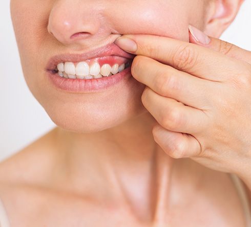Closeup of patient with red, inflamed gums