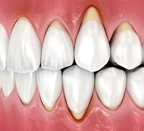 Illustration of gum recession