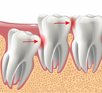 Illustration of impacted molar